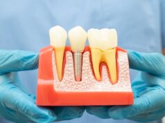 Что такое протезирование зубов?