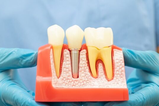 Что такое протезирование зубов?